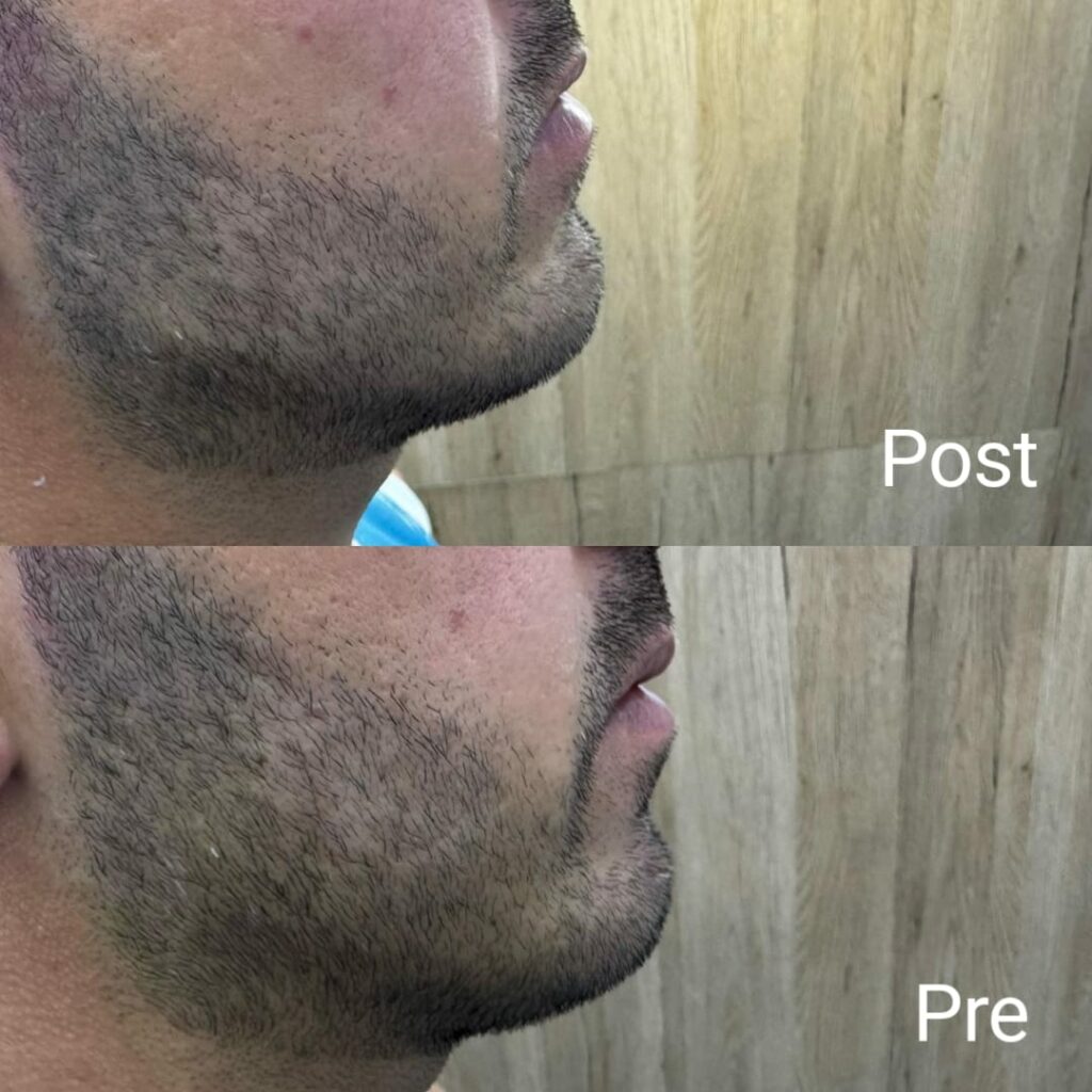 تحديد بسيط للفك بالفيلر